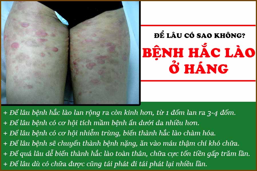 Bệnh Hắc Lào ở Háng để lâu có sao không