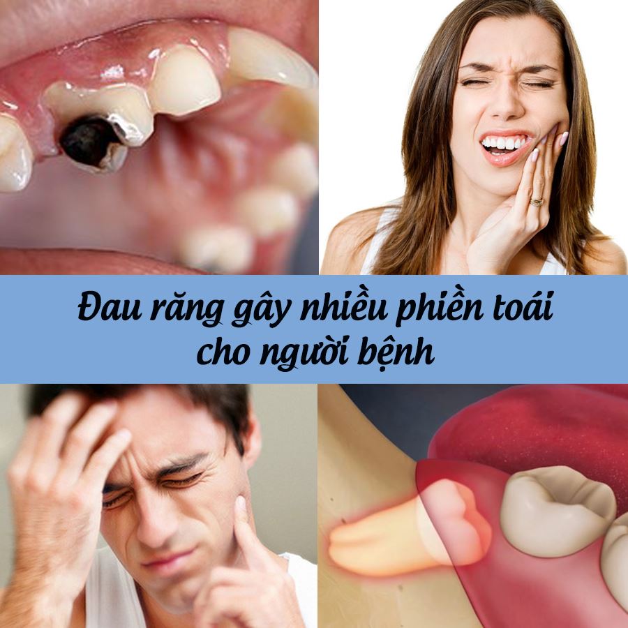 Đau răng gây nhiều phiền toái cho người bệnh